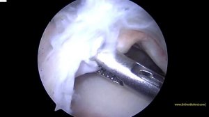 R large rotator cuff tear repaired arthroscopically with biceps tenodesis 8182016 GW