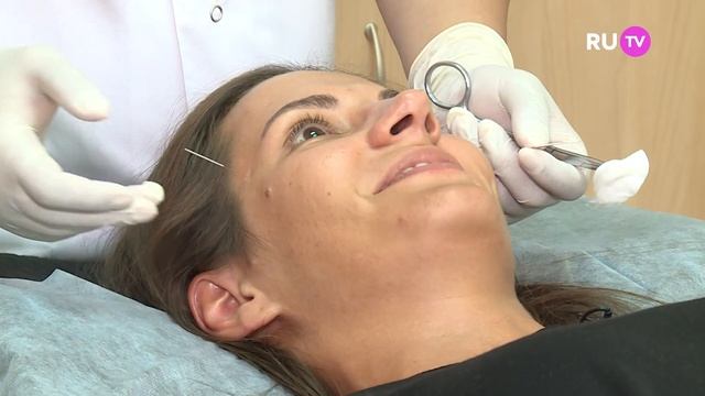 Эффективность иглоукалывания: проверено на звездах! | Ути-Beauty. Выпуск 56 смотреть онлайн