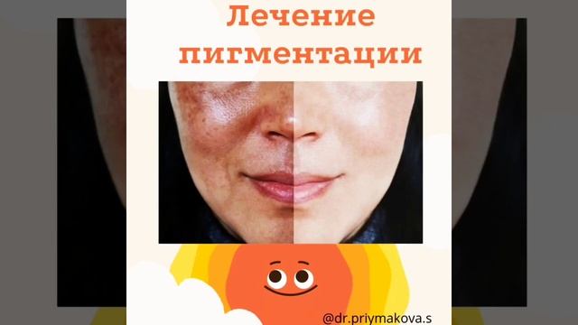 Как лечить пигментные пятна?!