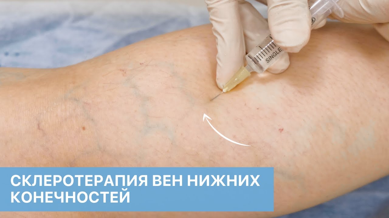 Безоперационное лечение варикоза. Склеротерапия вен нижних конечностей в ОН КЛИНИК.