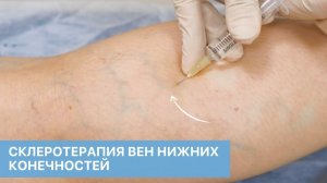 Безоперационное лечение варикоза. Склеротерапия вен нижних конечностей в ОН КЛИНИК.
