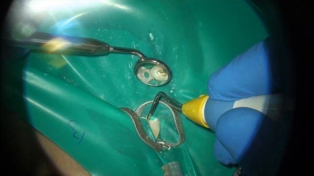 Пломбировка канала под микроскопом. Латеральные канальцы зубов смотреть онлайн