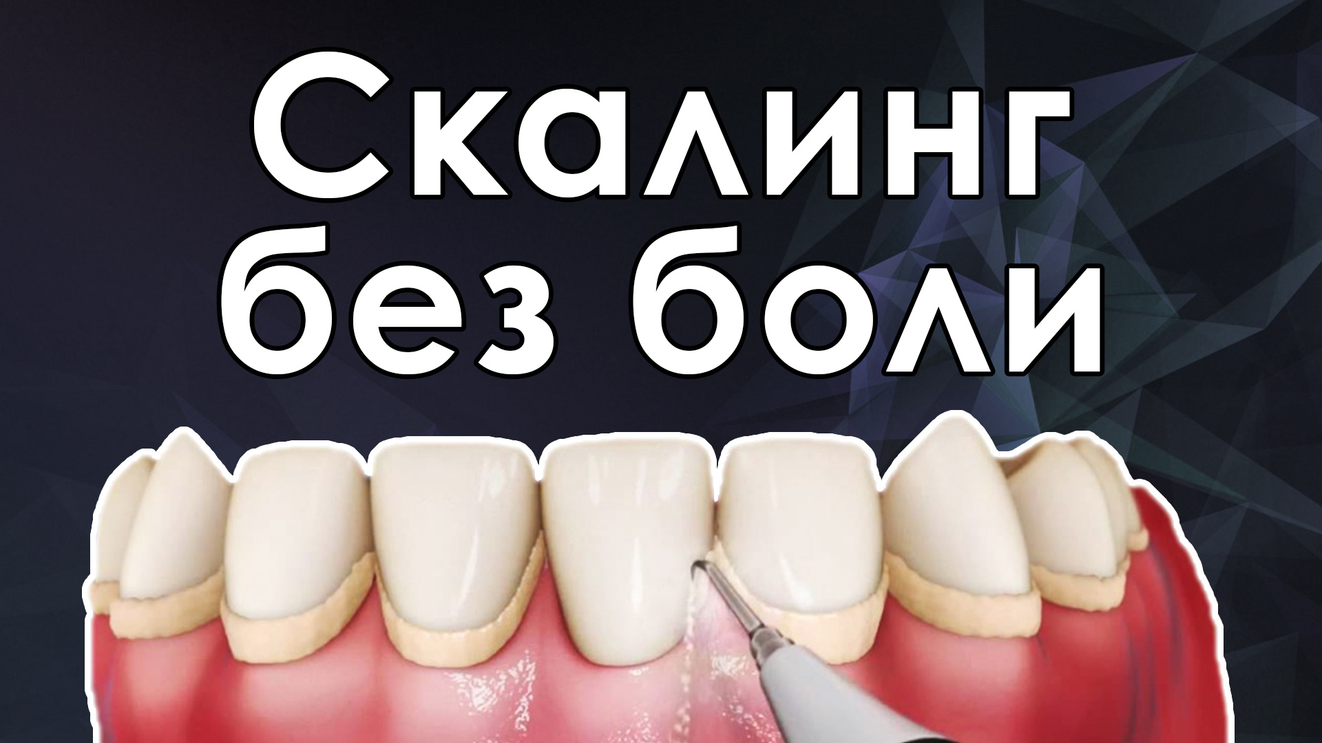 Удаление наддесневых отложений