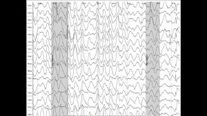 ЭЭГ: синдром Веста