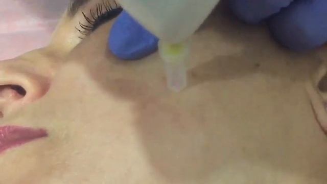 Демонстрация работы насадок для электроплазменного пилинга и удаления пигментных пятен смотреть онлайн