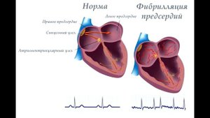 Симптомы аритмии сердца