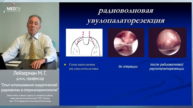 Радиоволновая хирургия в оториноларингологии, klinika29.ru