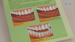 Имплантация, самая общая информация.