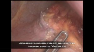 Лапароскопическая правосторонняя адреналэктомия