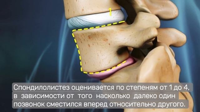 Спондилолизный спондилолистез