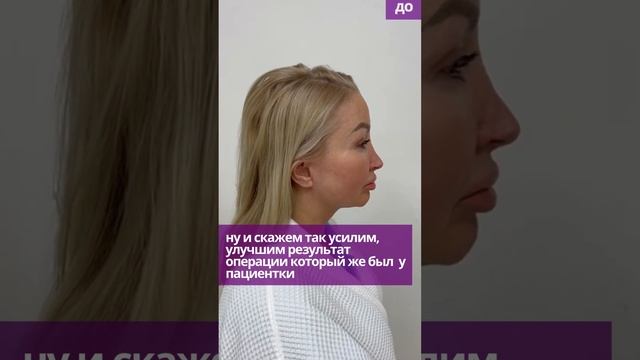 Как убрать второй подбородок / Выполнен радиочастотный липолиз нижней трети лица FACE TITE.