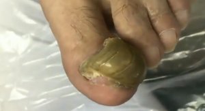 Онихогрифоз⚠️?❗️??