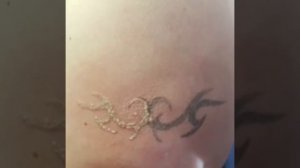 Сведение татуировки