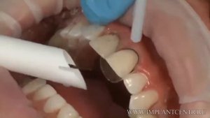 Обучение изготовлению и установке композитных виниров
