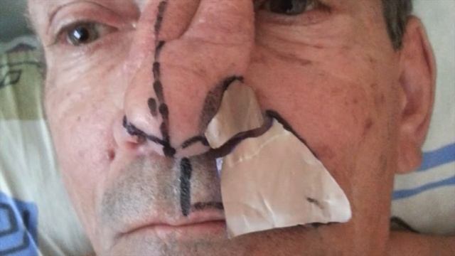 реконструкция наружного носа. Пластический хирург Дикарев Алексей.
