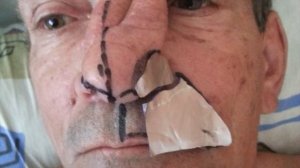 реконструкция наружного носа. Пластический хирург Дикарев Алексей.