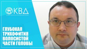 1160  Глубокая трихофития волосистой части головы