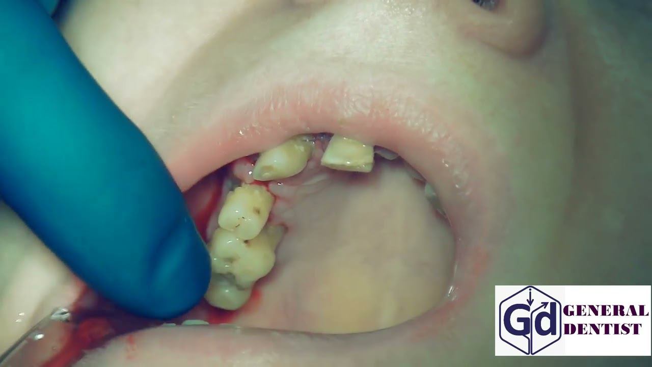 Removal of interrupted sutures after implantation in the area 12,14.