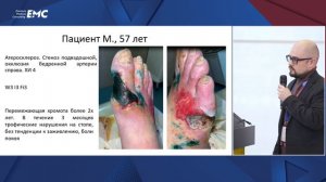 Доклад «Хирургия хронической ишемии нижних конечностей при инфраингвинальных поражениях артерий»