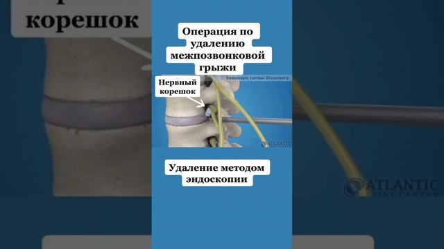 КАК УДАЛЯЮТ ГРЫЖУ❓ смотреть онлайн