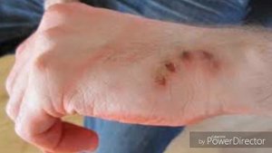 Что бывает после укуса кота или же кошки