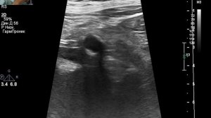 УЗИ сосудов нижних конечностей. Значимые изменения.