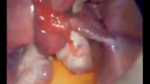 12 лапароскопия трубная берем