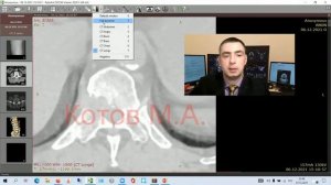 Литические метастазы позвоночника. Ролик №10