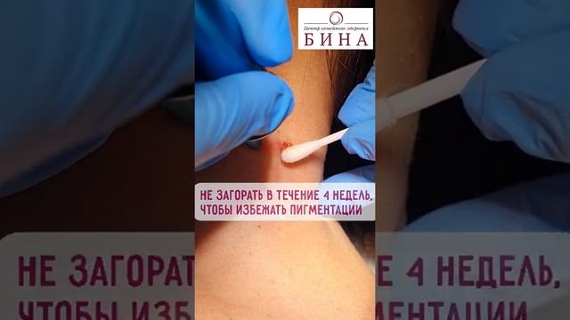 Как ухаживать за кожей после удаления новообразований СО2 лазером смотреть онлайн