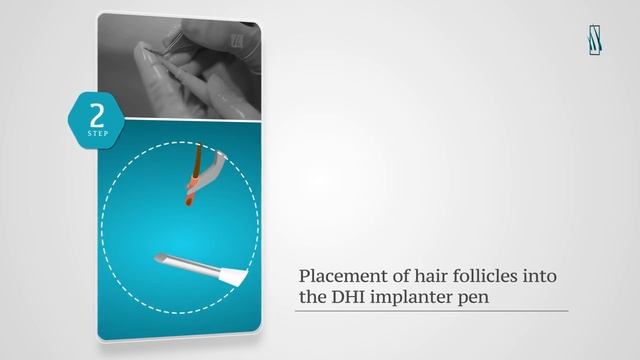 Пересадка волос методом FUE | Hairtransplantant
