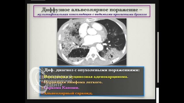 КТ пневмоний - аспирационная, некротическая пневмония, септическая эмболия. Андрей Мангов. Часть 2