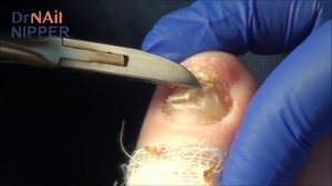 Do thick toenails hurt?  Nervous Patient with Dr Nail Nipper {Throwback]