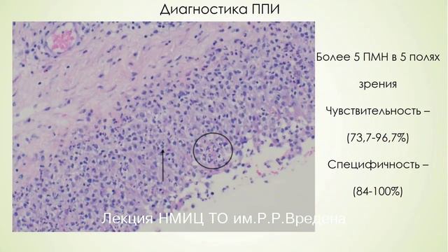 Факторы риска, диагностики и лечения перипротезной инфекции коленного сустава.