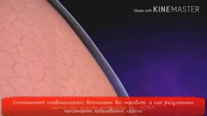 Спонтанный пневмоторакс