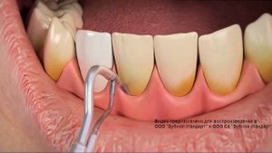 Гигиена зубов Челябинск. Зубной Стандарт - умная стоматология