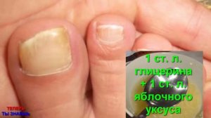 Опустите Ноги на 20 Минут, ГРИБОК Ногтей и ПОТЛИВОСТЬ Ног Навсегда Исчезнут!