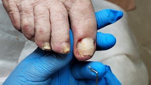 Пиогенная гранулёма / Мясо под ногтем/ Трещина на ногте