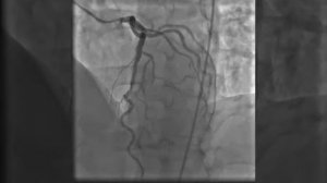 Результаты коронарографии