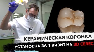 Протезирование зубов коронка за 3 часа CEREC Стас Белоус #Suprinity #vitazahnfabrik