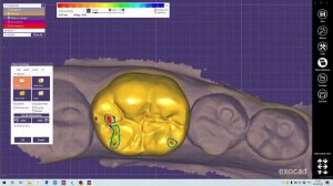 База по Exocad: Моделирование зуба на культе