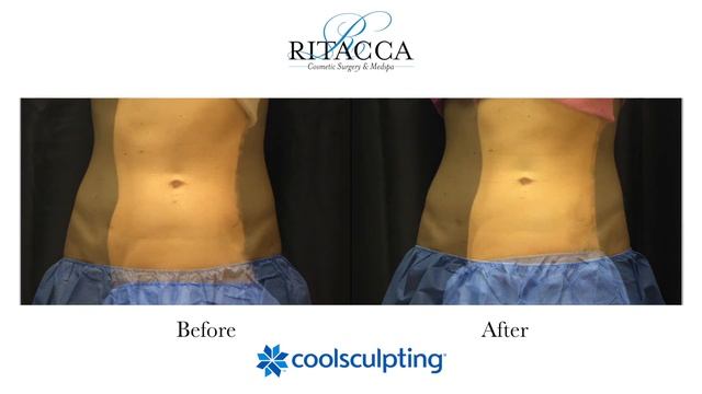 2020 Virtual Open House Coolsculpting смотреть онлайн