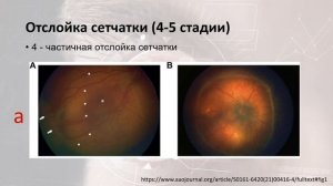 Международная классификация ретинопатии недоношенных, 3 пересмотр. 2021г.