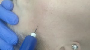 Удаление лентигинозных (пигментных пятен) на лице с помощью холодной плазмы