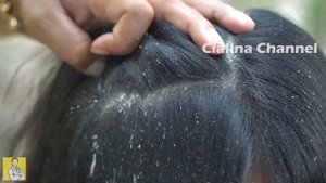 Hair Combing Dandruff / Cialina Channel 1140
