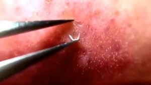 Достаём червей из носа! Выдавливание прыща! Alter