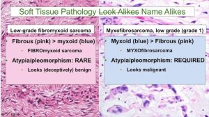 ФИБРОмиксосаркома VS МИКСОфибросаркома