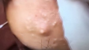 Acne mature!!! Огромные прыщи на голове у девушки!!!!