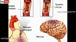 УНИКАЛЬНЫЕ РЕЦЕПТЫ ОЧИСТКИ СОСУДОВ ТЕЛА И ГОЛОВНОГО МОЗГА.УЛУЧШЕНИЕ КРОВООБРАЩЕНИЯ