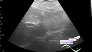 Детское УЗИ брюшной полости -  Псевдоопухоль печени