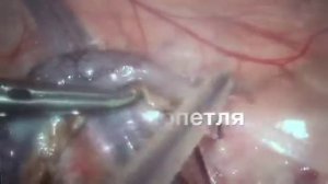 лапароскопическая аппендэктомия №2